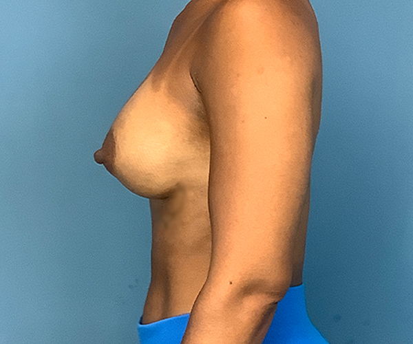 after breast augmentation left side view case 2187