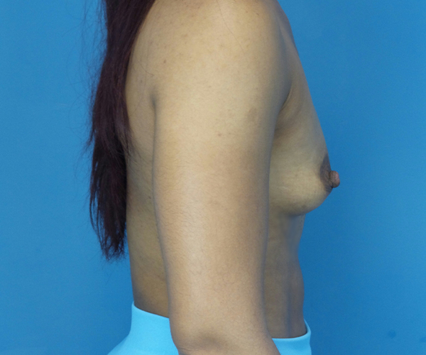 before breast augmentation right side view case 2187