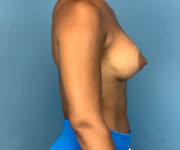 after breast augmentation right side view case 2187
