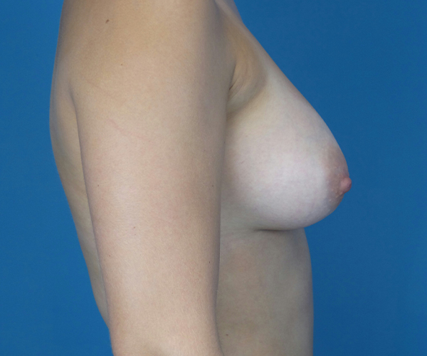 after breast augmentation right side view case 2198