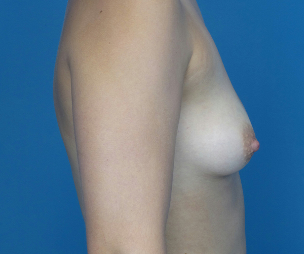 before breast augmentation right side view case 2198