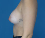 after breast augmentation left side view case 2198