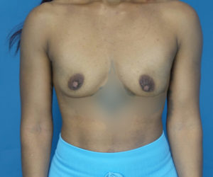 before breast augmentation front view case 2187
