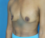 before breast augmentation left angle view case 2187
