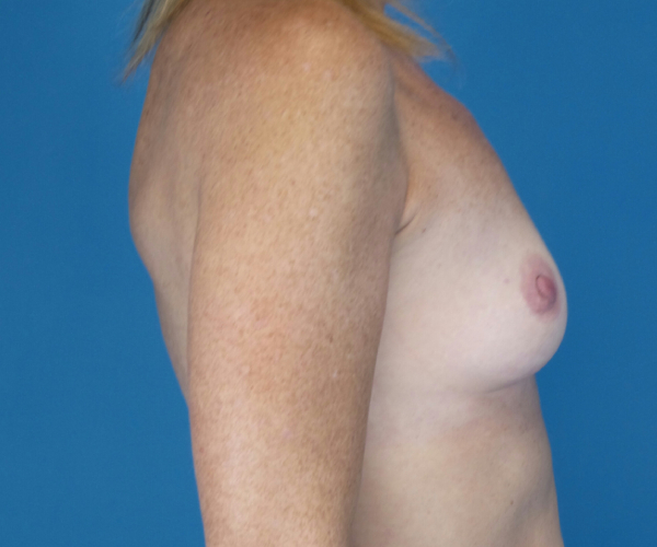 before breast augmentation right side view case 2927