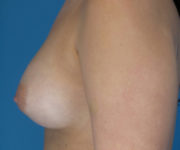 after breast augmentation left side view case 2938 | Crispin Plastic Surgery Atlanta, GA