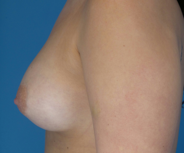 after breast augmentation left side view case 2938 | Crispin Plastic Surgery Atlanta, GA