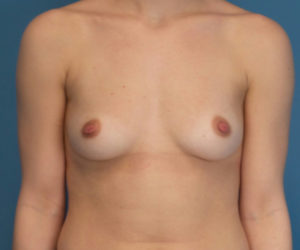 before breast augmentation front view case 2949 | Crispin Plastic Surgery Atlanta, GA