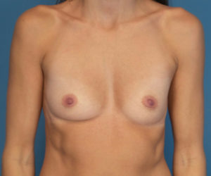 before breast augmentation front view case 2976