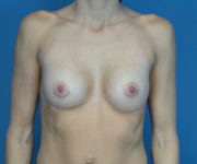 after breast augmentation front view case 2976