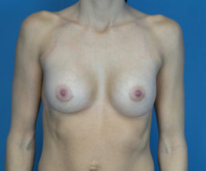 after breast augmentation front view case 2976