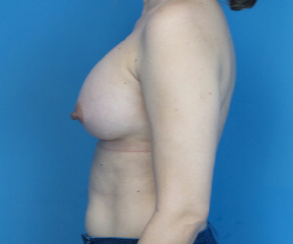after breast augmentation left side view case 2987 | Crispin Plastic Surgery Atlanta, GA