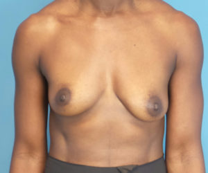 before breast augmentation front view case 2998 | Crispin Plastic Surgery Atlanta, GA