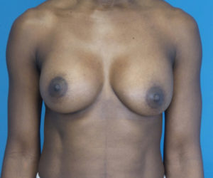 after breast augmentation front view case 2998 | Crispin Plastic Surgery Atlanta, GA