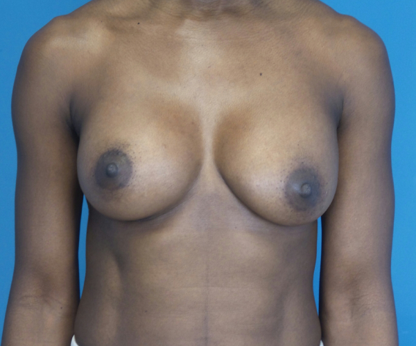 after breast augmentation front view case 2998 | Crispin Plastic Surgery Atlanta, GA