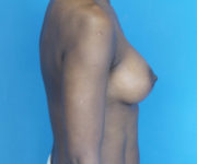 after breast augmentation right side view case 2998 | Crispin Plastic Surgery Atlanta, GA