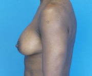 after breast augmentation left side view case 2998 | Crispin Plastic Surgery Atlanta, GA