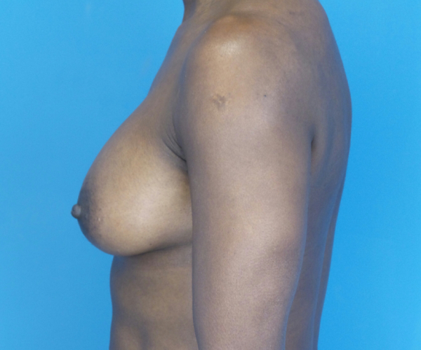 after breast augmentation left side view case 2998 | Crispin Plastic Surgery Atlanta, GA