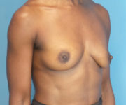 before breast augmentation right angled view case 2998 | Crispin Plastic Surgery Atlanta, GA