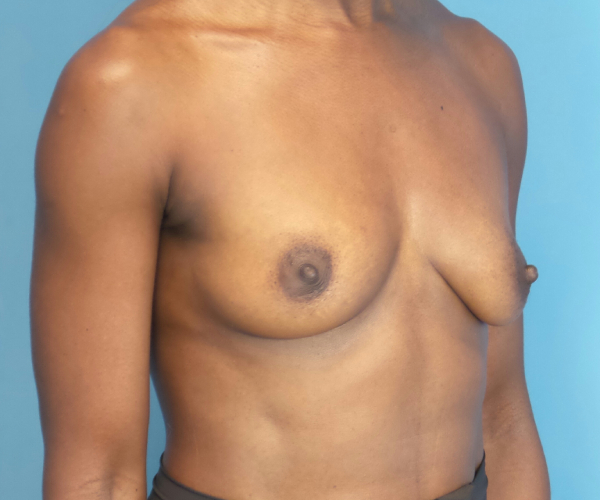 before breast augmentation right angled view case 2998 | Crispin Plastic Surgery Atlanta, GA