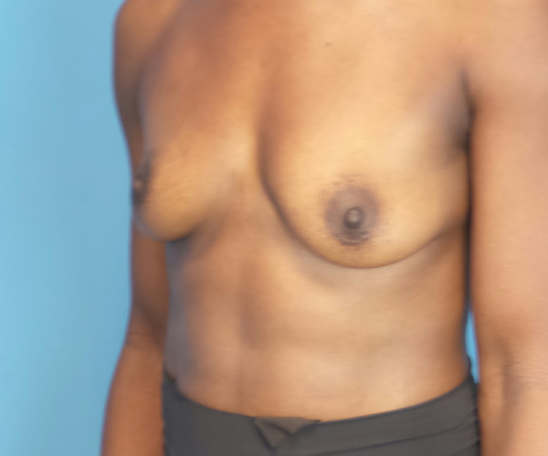 before breast augmentation left angled view case 2998 | Crispin Plastic Surgery Atlanta, GA