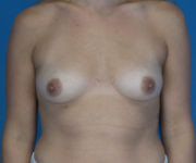 before breast augmentation front view case 3018