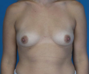 before breast augmentation front view case 3018