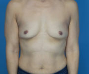before breast augmentation front view case 3029