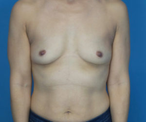 before breast augmentation front view case 3029
