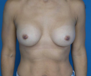 after breast augmentation front view case 3029