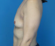 before breast augmentation left side view case 3029