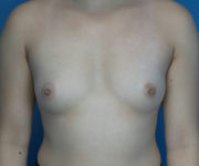 before breast augmentation front view case 3040