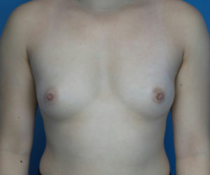 before breast augmentation front view case 3040