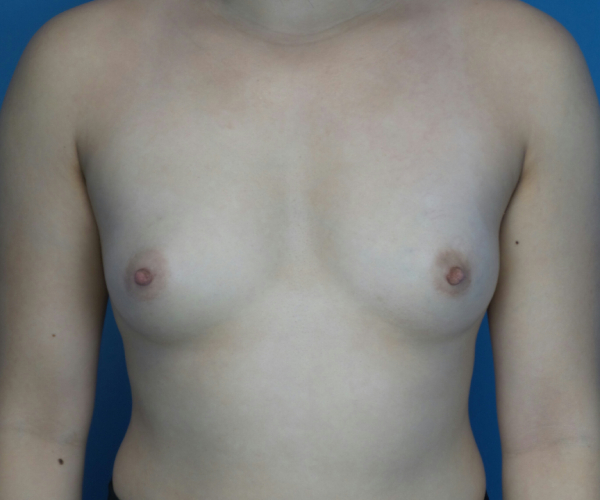 before breast augmentation front view case 3040