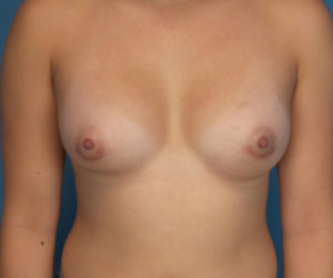 after breast augmentation front view case 3040