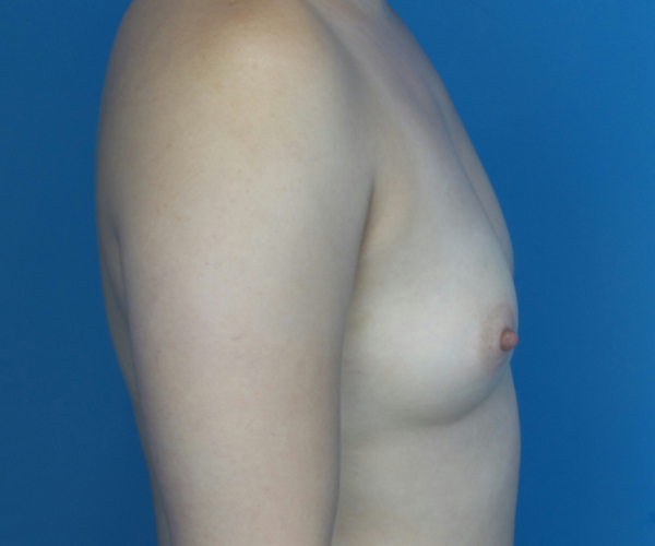 before breast augmentation right side view case 3040