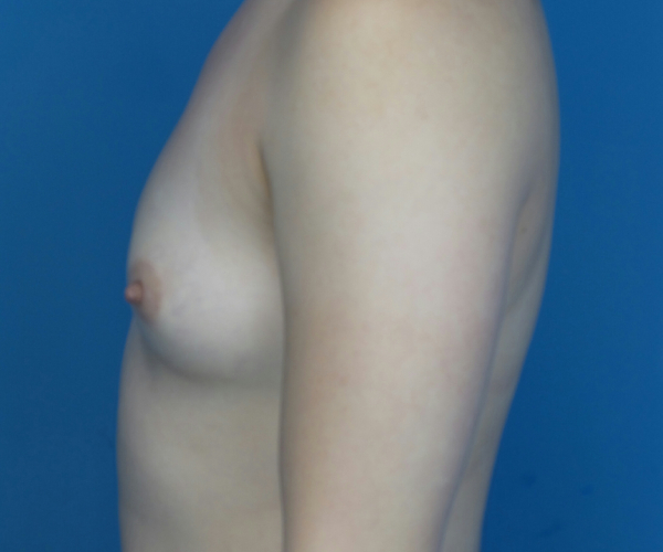 before breast augmentation left side view case 3040
