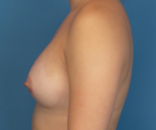 after breast augmentation left side view case 3040