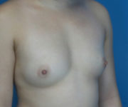 before breast augmentation right angled view case 3040