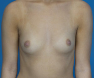 before breast augmentation front view case 3076