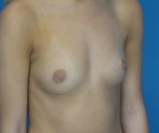 before breast augmentation right angled view case 3076