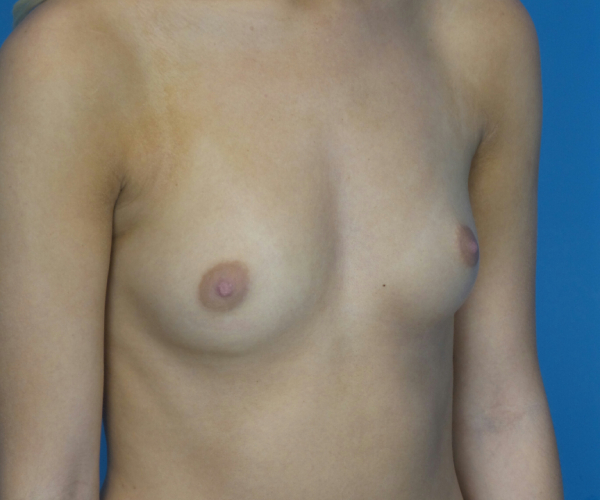 before breast augmentation right angled view case 3076
