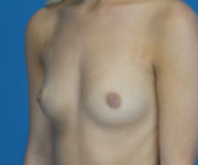 before breast augmentation left angled view case 3076