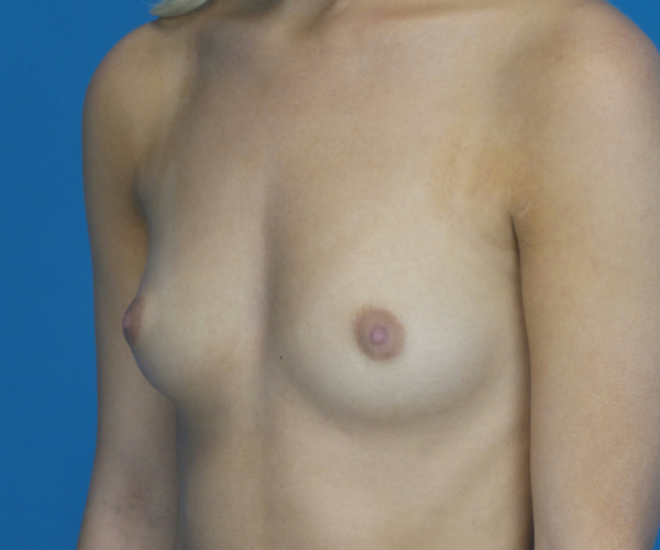 before breast augmentation left angled view case 3076