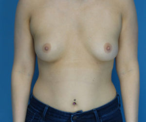 before breast augmentation front view case 3087