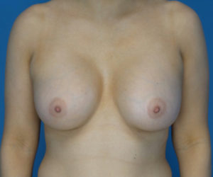 after breast augmentation front view case 3087