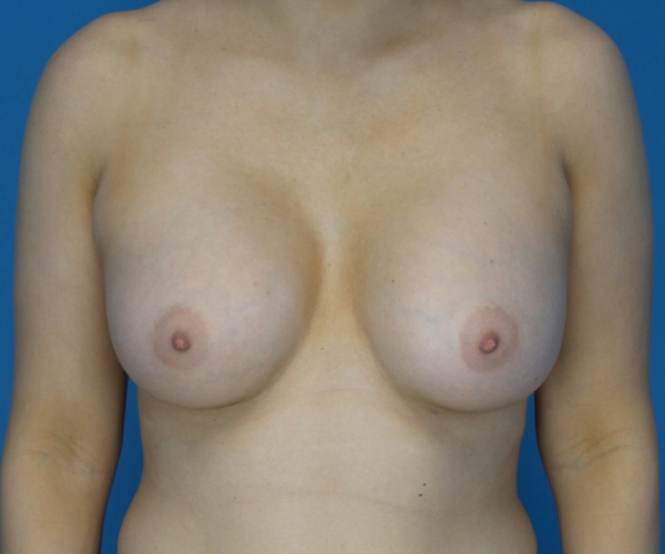 after breast augmentation front view case 3087