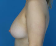 after breast augmentation left side view case 3087