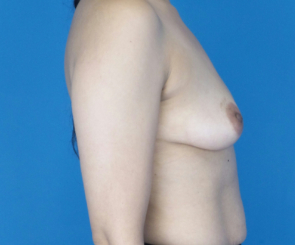 before breast augmentation right side view case 3098