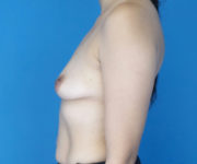 before breast augmentation left side view case 3098